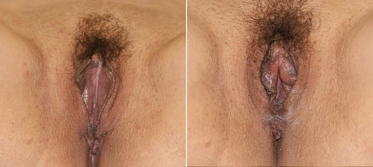Vaginoplasty before and after photos in Houston, TX, Patient 29683