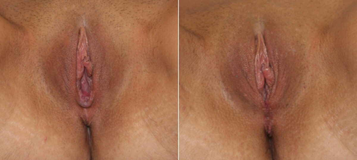 Vaginoplasty before and after photos in Houston, TX, Patient 29689