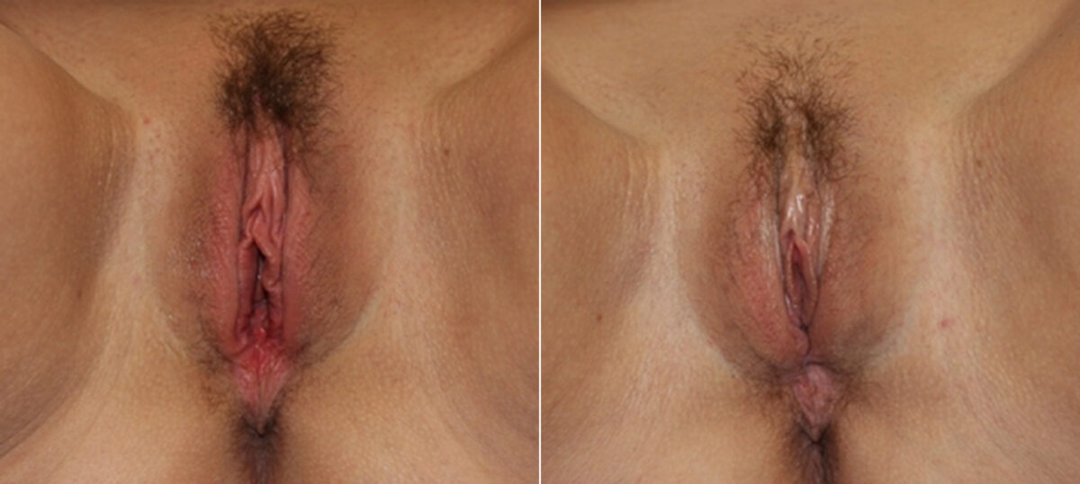 Vaginoplasty before and after photos in Houston, TX, Patient 29695