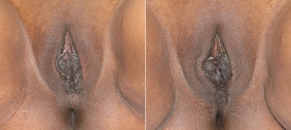 Vaginoplasty before and after photos in Houston, TX, Patient 29704