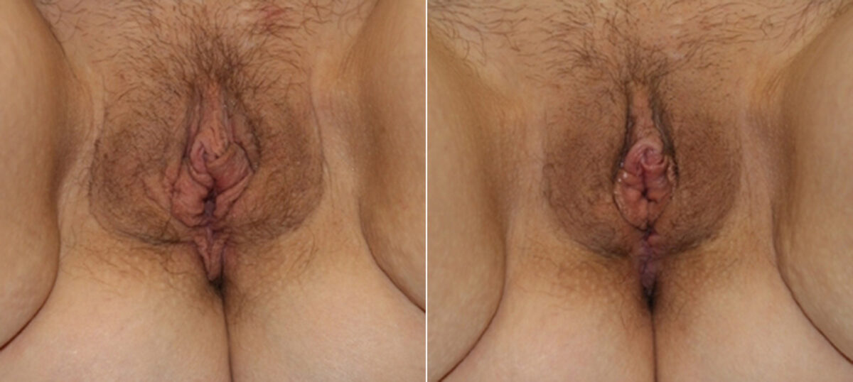 Vaginoplasty before and after photos in Houston, TX, Patient 29707