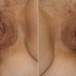 Vaginoplasty before and after photos in Houston, TX, Patient 29707
