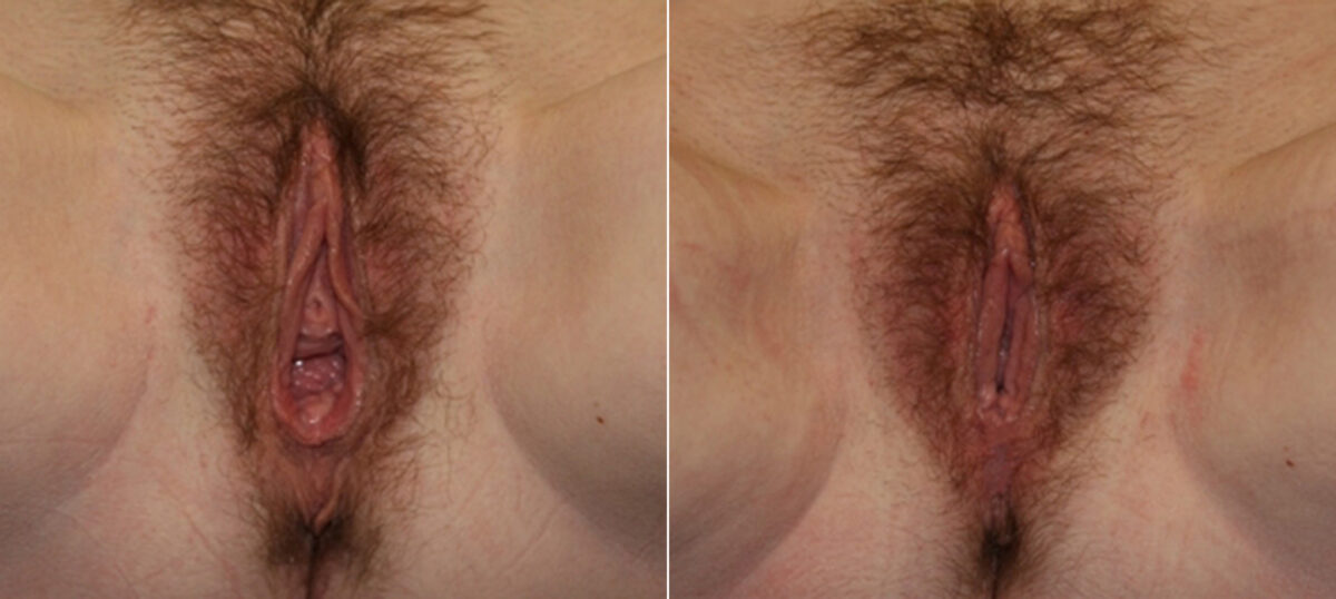 Vaginoplasty before and after photos in Houston, TX, Patient 29713