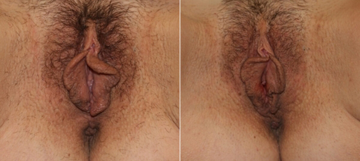 Vaginoplasty before and after photos in Houston, TX, Patient 29716