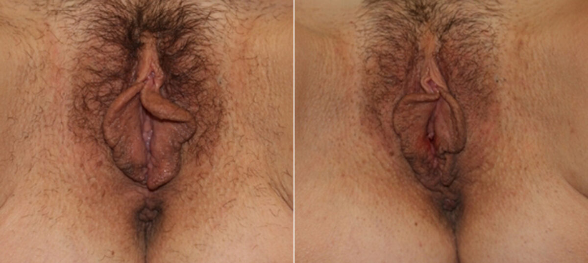 Patient 29716, Vaginoplasty before and after photos Vaginoplasty before and after photos in Houston, TX, Patient 29716
