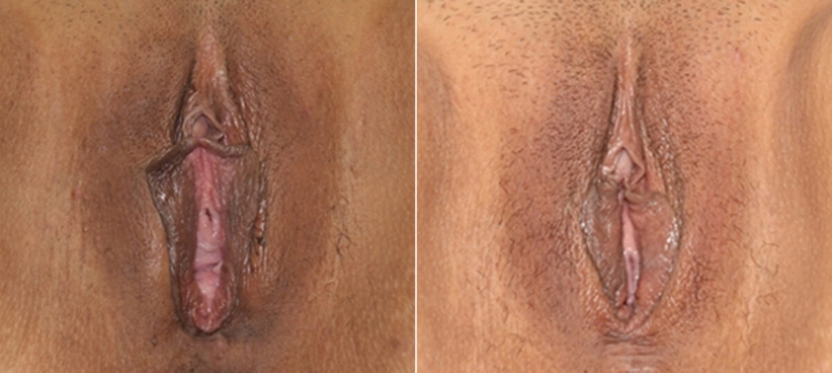 Vaginoplasty before and after photos in Houston, TX, Patient 29719