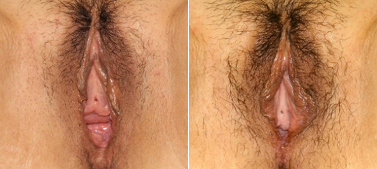 Vaginoplasty before and after photos in Houston, TX, Patient 29725