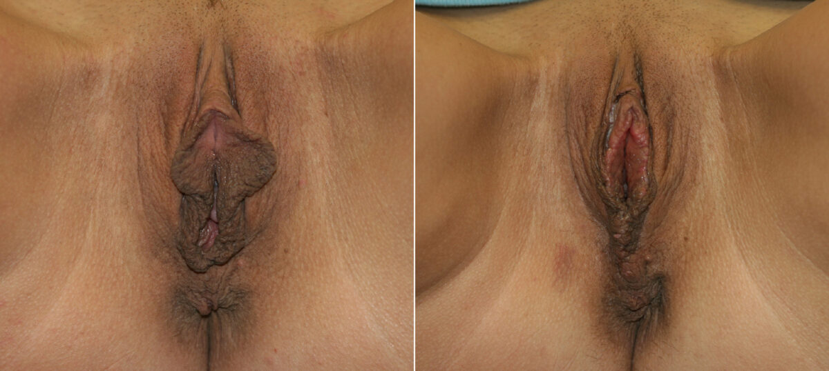 Vaginoplasty before and after photos in Houston, TX, Patient 29728