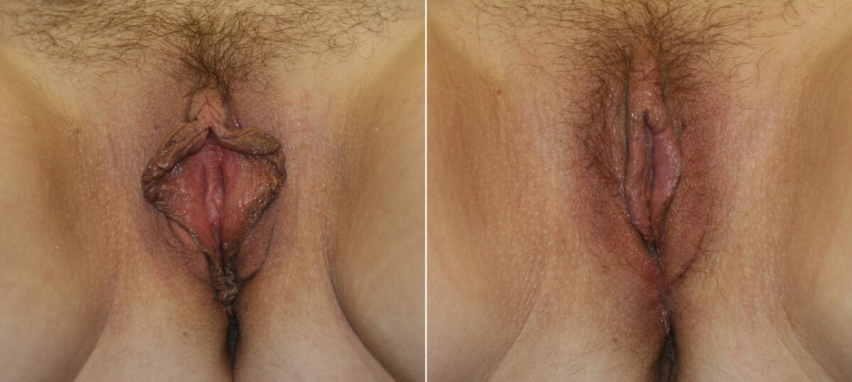 Vaginoplasty before and after photos in Houston, TX, Patient 29731
