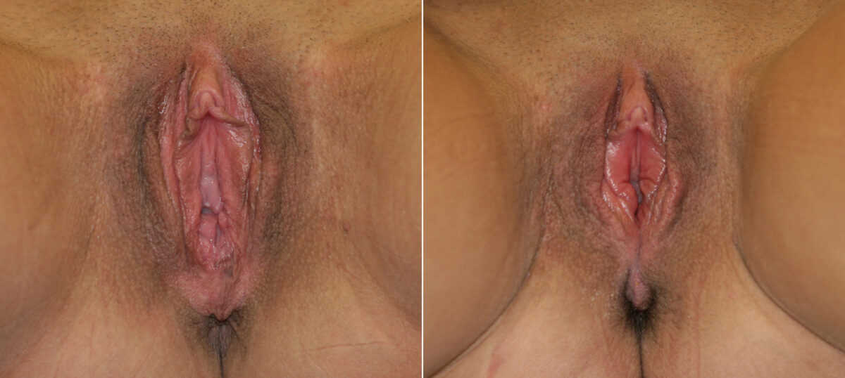 Vaginoplasty before and after photos in Houston, TX, Patient 29734