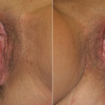 Vaginoplasty before and after photos in Houston, TX, Patient 29734