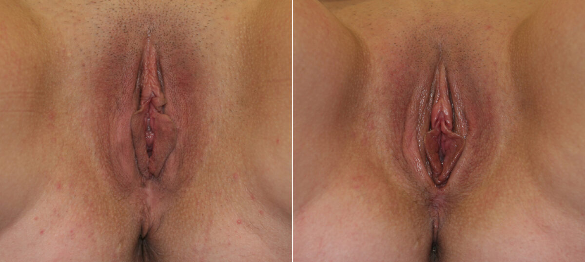 Vaginoplasty before and after photos in Houston, TX, Patient 29746