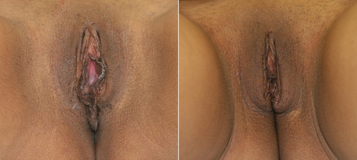 Vaginoplasty before and after photos in Houston, TX, Patient 29749