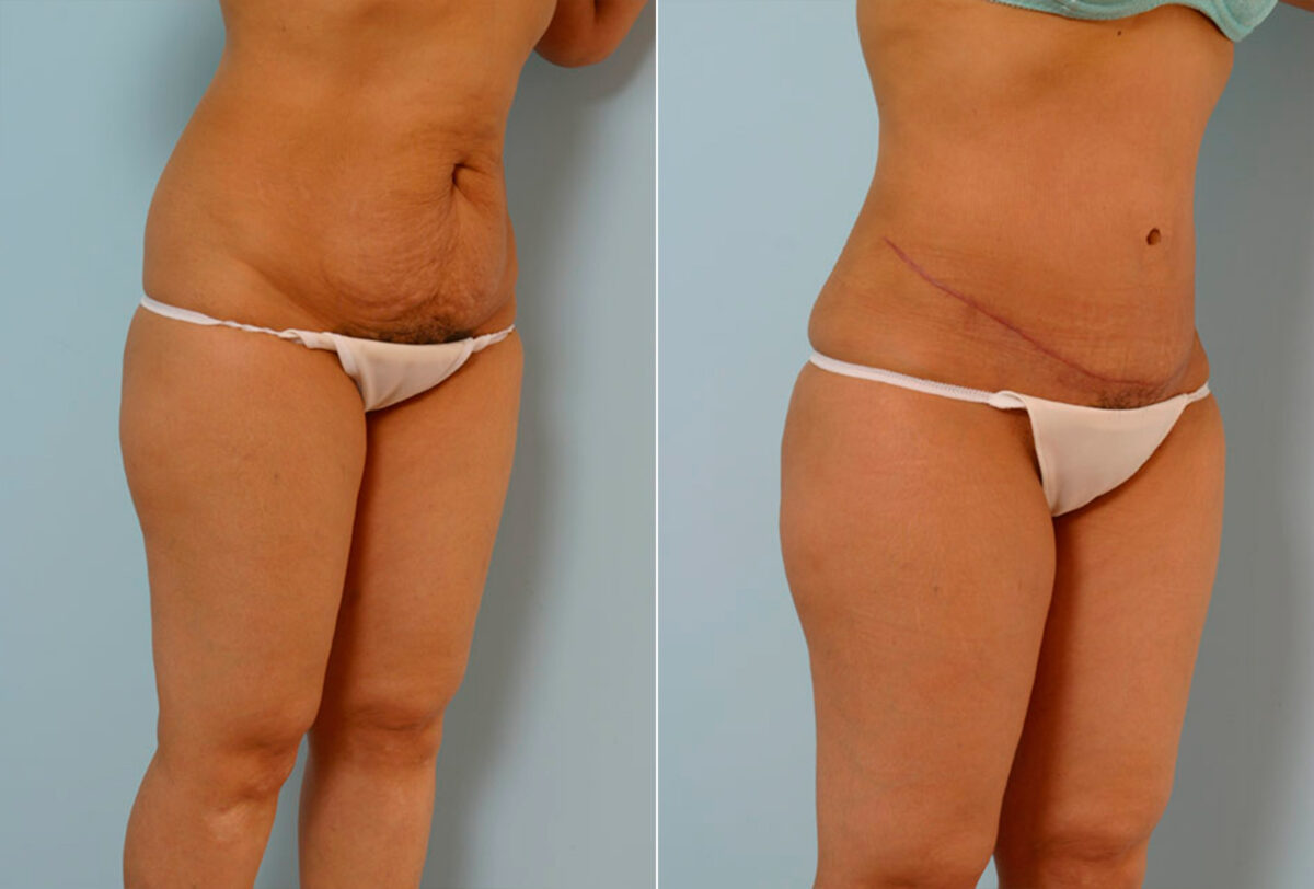 Abdominoplasty before and after photos in Houston, TX, Patient 24269