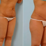 Abdominoplasty before and after photos in Houston, TX, Patient 24269