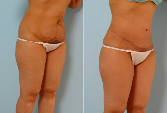 Tummy Tuck/Abdominoplasty before and after photos in Houston, TX, Patient 24269