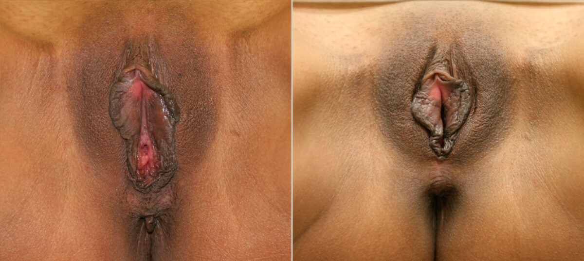 Vaginoplasty before and after photos in Houston, TX, Patient 29755