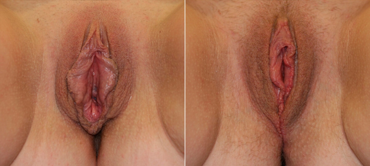 Vaginoplasty before and after photos in Houston, TX, Patient 29758