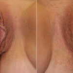 Vaginoplasty before and after photos in Houston, TX, Patient 29758