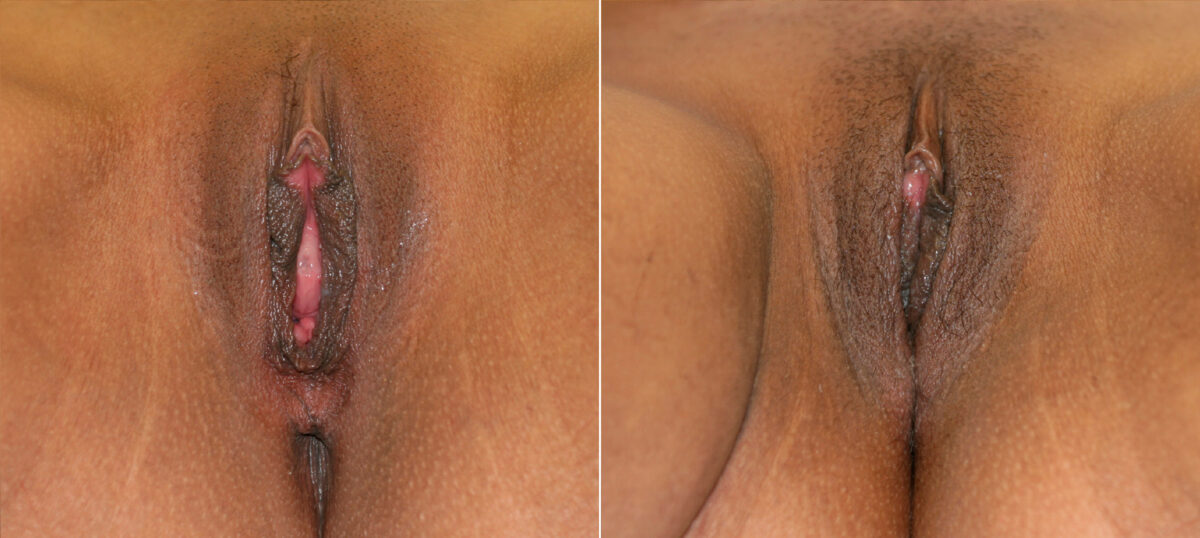 Vaginoplasty before and after photos in Houston, TX, Patient 29761