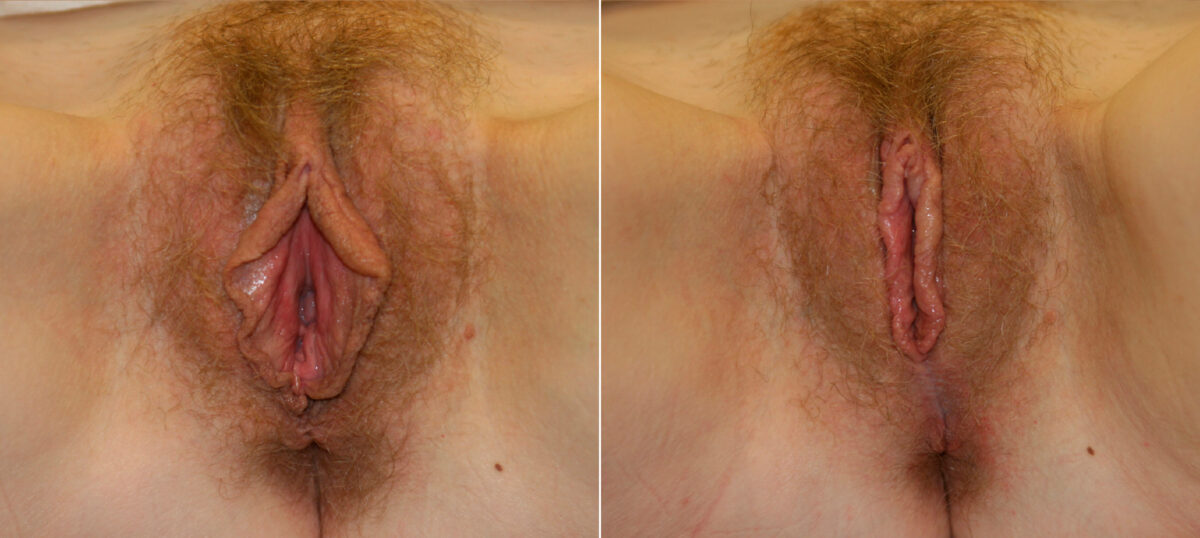 Vaginoplasty before and after photos in Houston, TX, Patient 29767