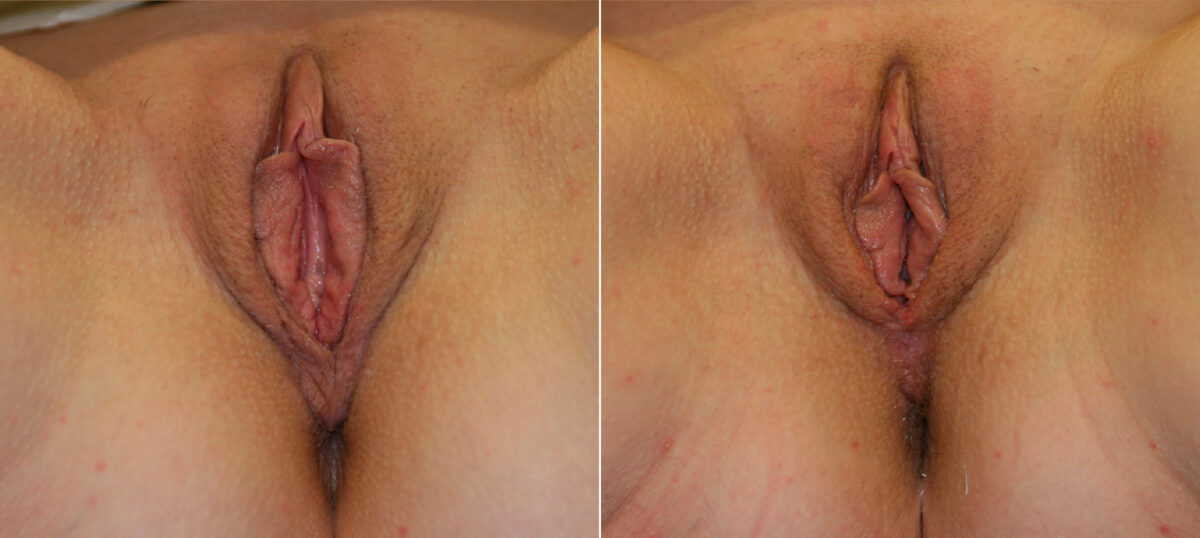 Vaginoplasty before and after photos in Houston, TX, Patient 29773