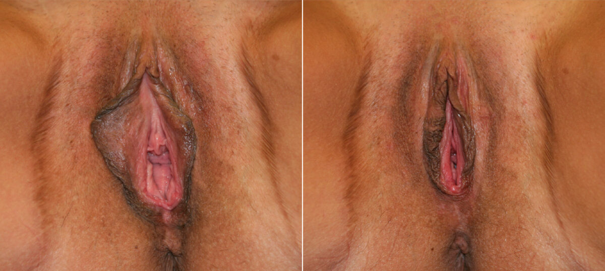 Vaginoplasty before and after photos in Houston, TX, Patient 29779