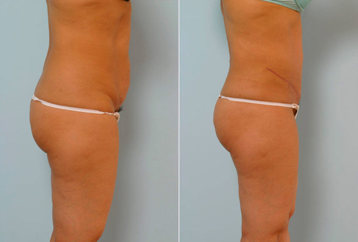 Abdominoplasty before and after photos in Houston, TX, Patient 24269