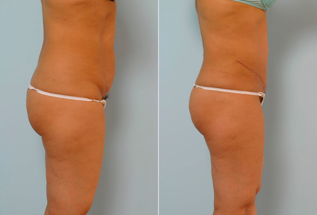 Tummy Tuck/Abdominoplasty before and after photos in Houston, TX, Patient 24269