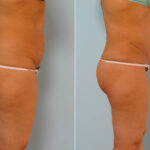 Abdominoplasty before and after photos in Houston, TX, Patient 24269