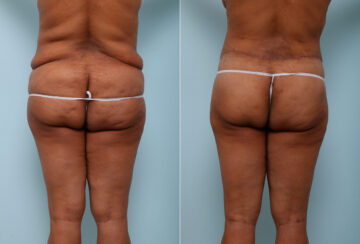 Back Lift before and after photos in Houston, TX, Patient 43073