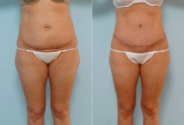 Abdominoplasty before and after photos in Houston, TX, Patient 24283