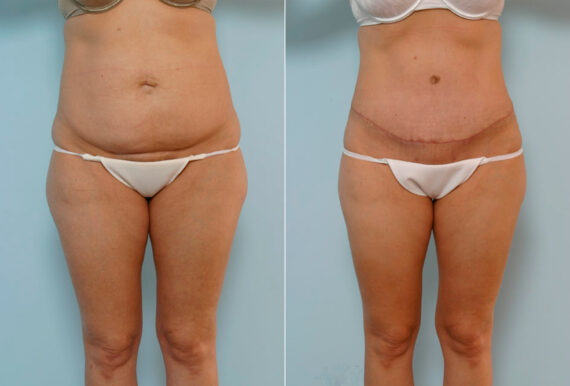 Tummy Tuck/Abdominoplasty before and after photos in Houston, TX, Patient 24283