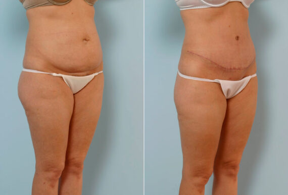 Tummy Tuck/Abdominoplasty before and after photos in Houston, TX, Patient 24283