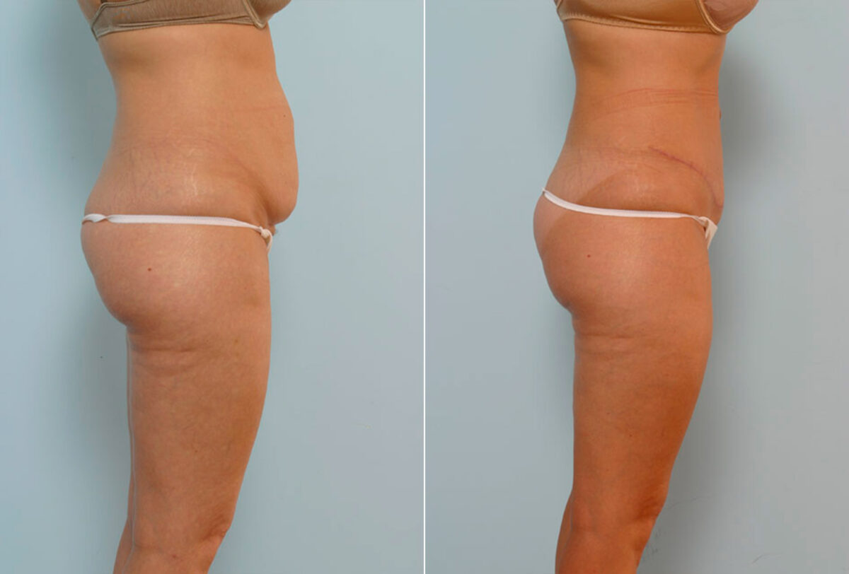 Abdominoplasty before and after photos in Houston, TX, Patient 24283