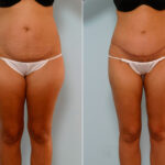 Abdominoplasty before and after photos in Houston, TX, Patient 24299