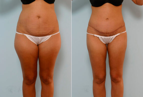 Tummy Tuck/Abdominoplasty before and after photos in Houston, TX, Patient 24299