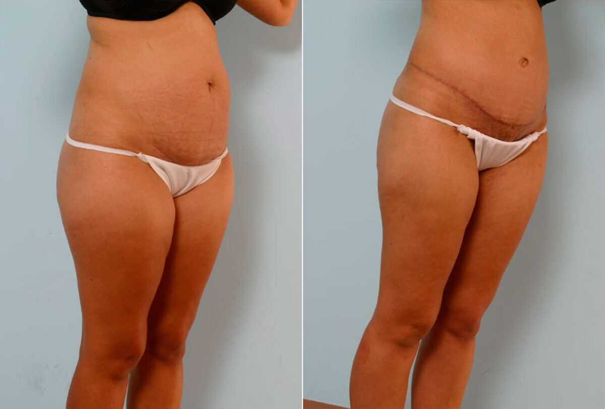 Abdominoplasty before and after photos in Houston, TX, Patient 24299