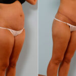 Abdominoplasty before and after photos in Houston, TX, Patient 24299