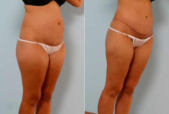 Tummy Tuck/Abdominoplasty before and after photos in Houston, TX, Patient 24299