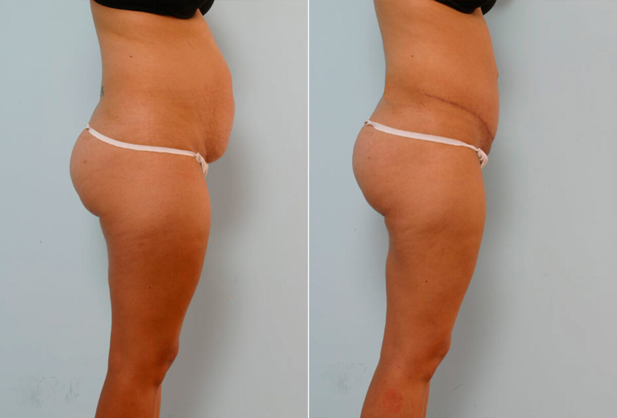 Tummy Tuck/Abdominoplasty before and after photos in Houston, TX, Patient 24299