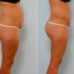 Abdominoplasty before and after photos in Houston, TX, Patient 24299