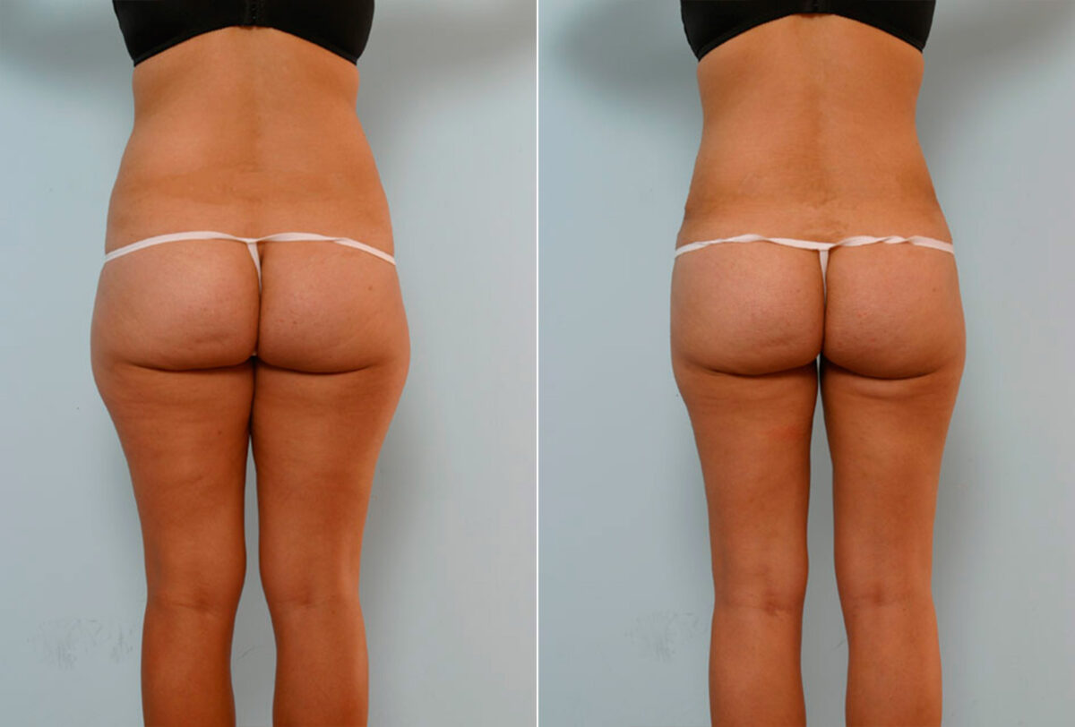 Tummy Tuck/Abdominoplasty before and after photos in Houston, TX, Patient 24299
