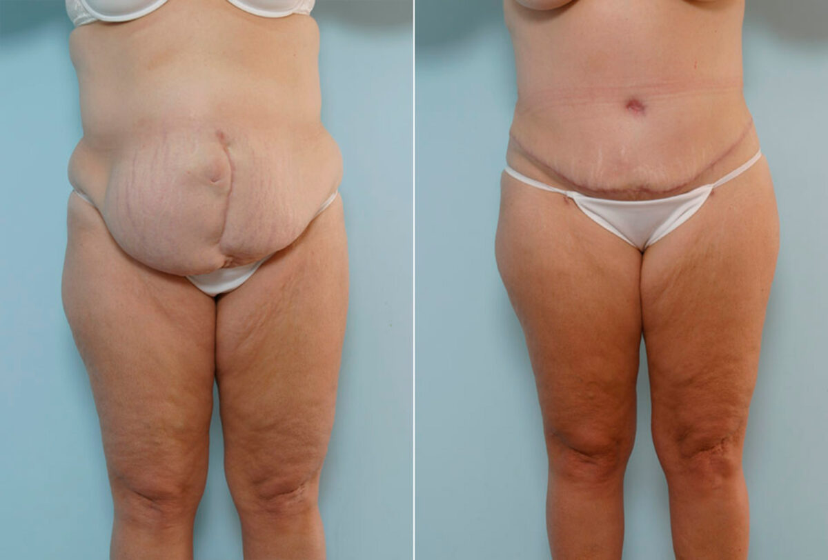 Tummy Tuck/Abdominoplasty before and after photos in Houston, TX, Patient 24308