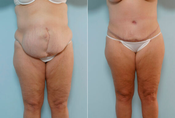 Abdominoplasty before and after photos in Houston, TX, Patient 24308