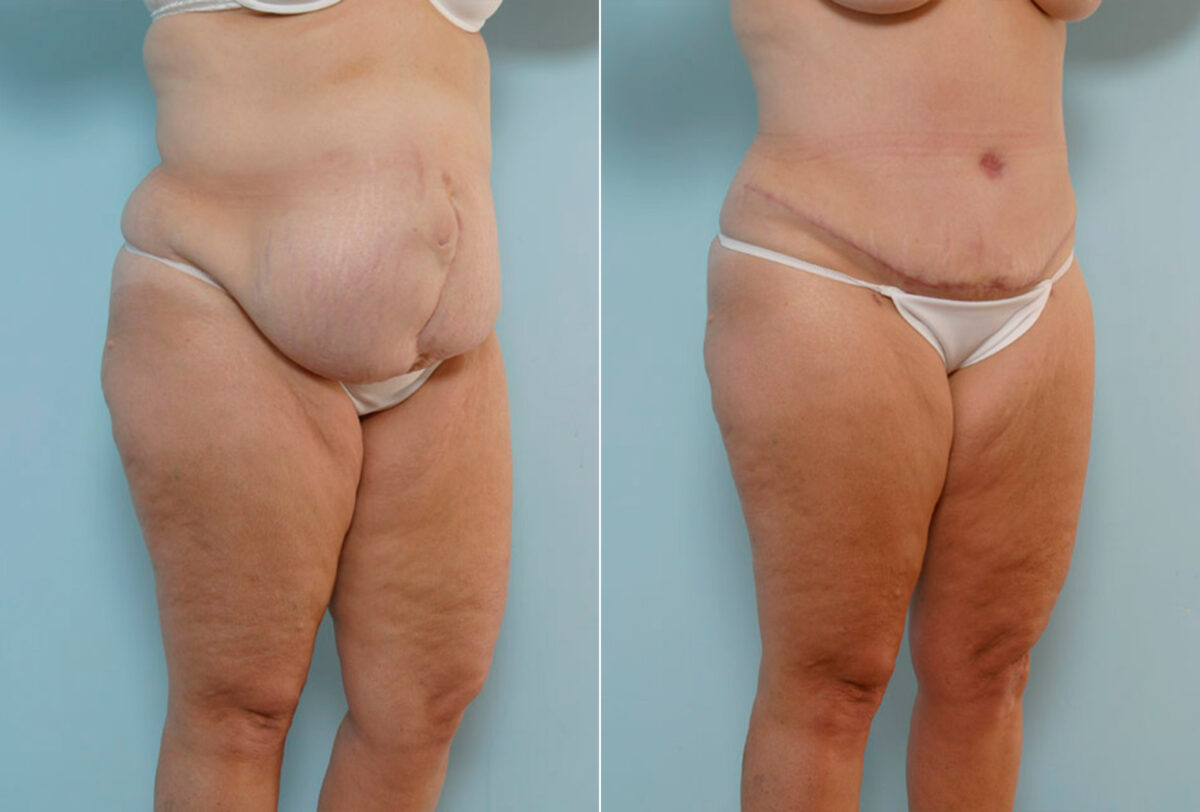 Abdominoplasty before and after photos in Houston, TX, Patient 24308