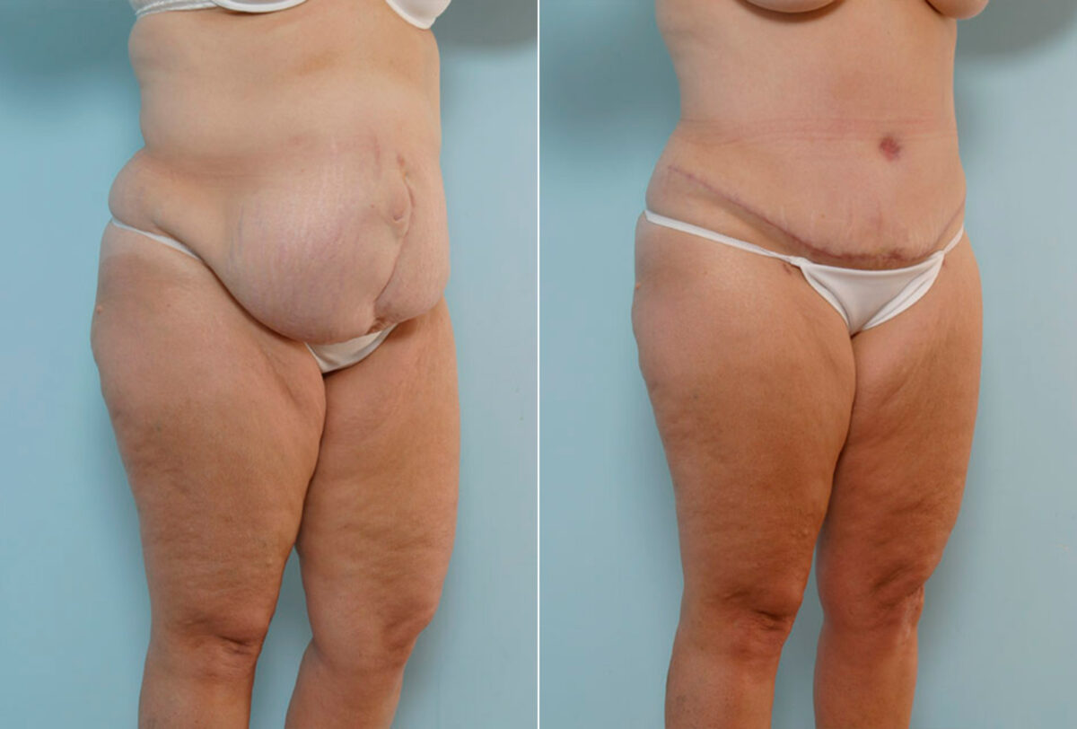 Tummy Tuck/Abdominoplasty before and after photos in Houston, TX, Patient 24308
