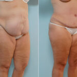 Abdominoplasty before and after photos in Houston, TX, Patient 24308