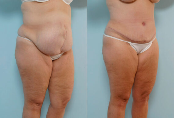 Tummy Tuck/Abdominoplasty before and after photos in Houston, TX, Patient 24308