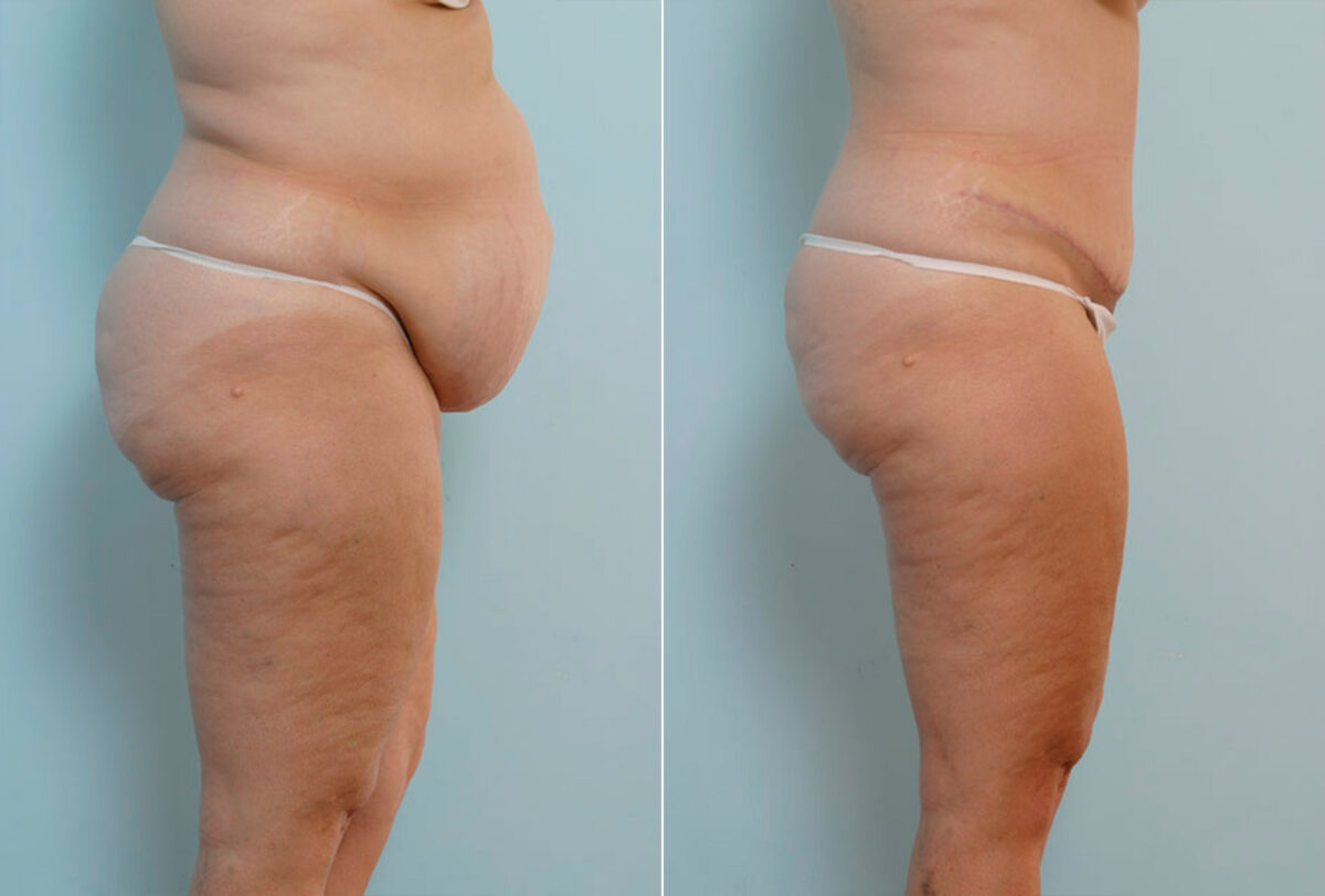 Abdominoplasty before and after photos in Houston, TX, Patient 24308